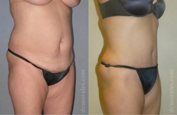 Before & After Tummy Tuck Case 484 View 1 View in Houston, TX