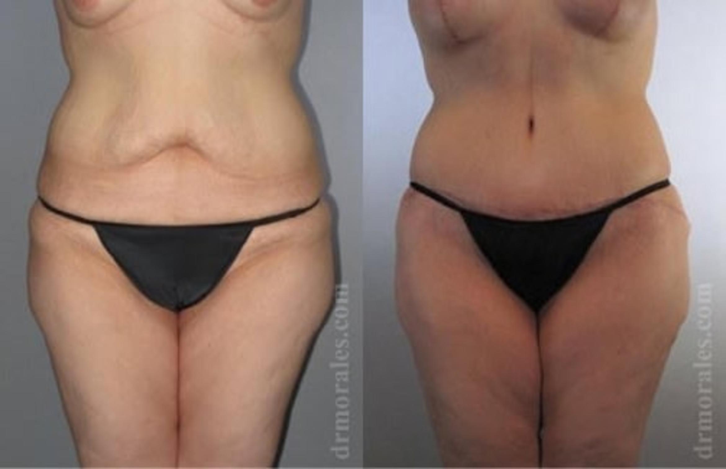 Before & After Tummy Tuck Case 485 View 1 View in Houston, TX