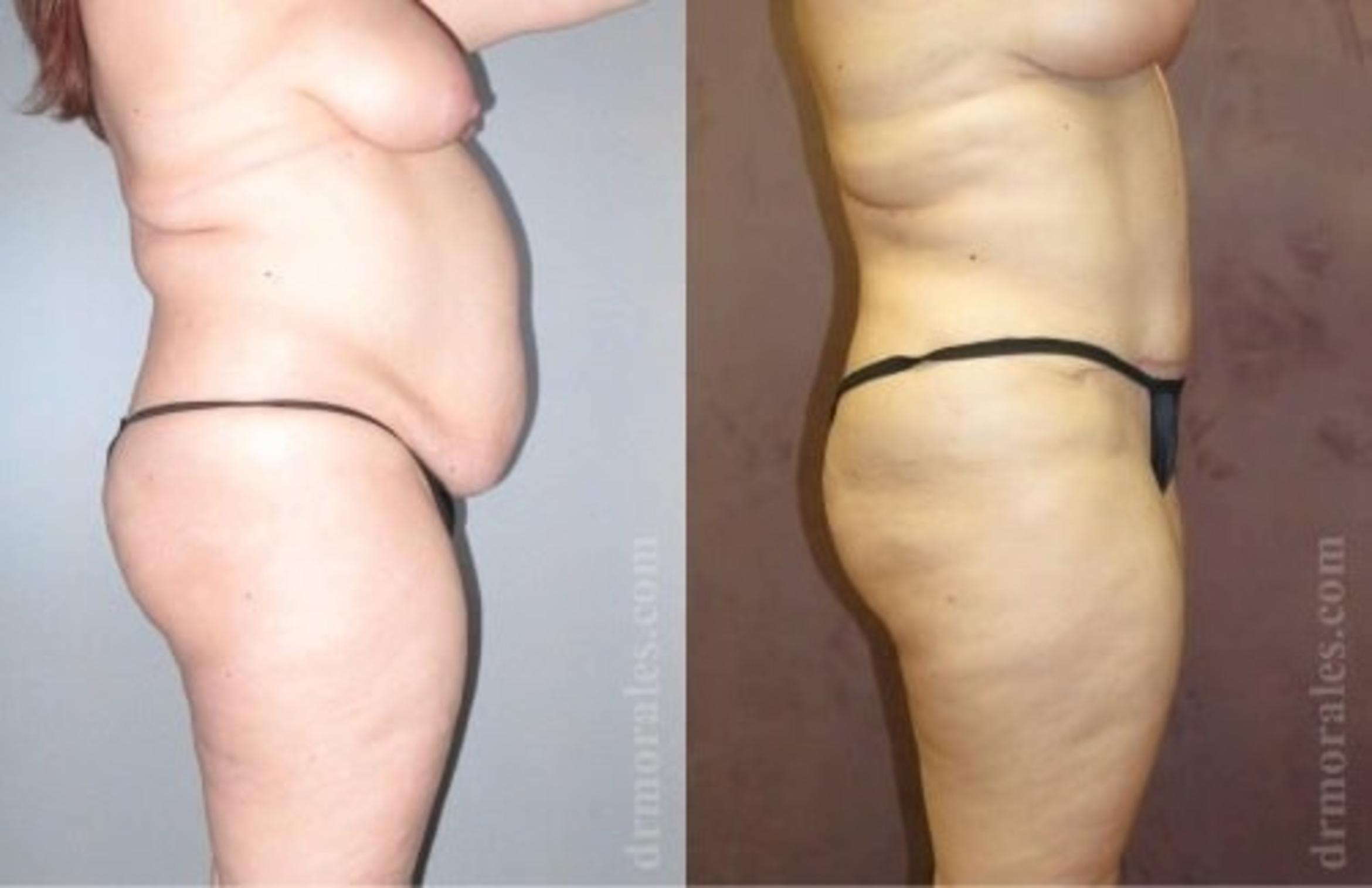 Before & After Tummy Tuck Case 486 View 1 View in Houston, TX