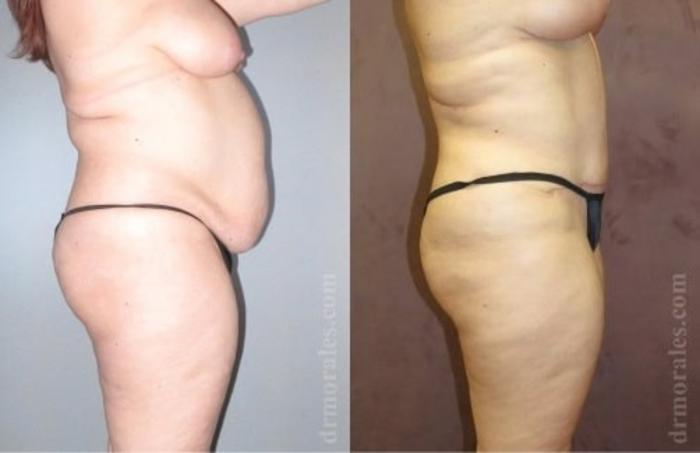 Before & After Tummy Tuck Case 486 View 1 View in Houston, TX