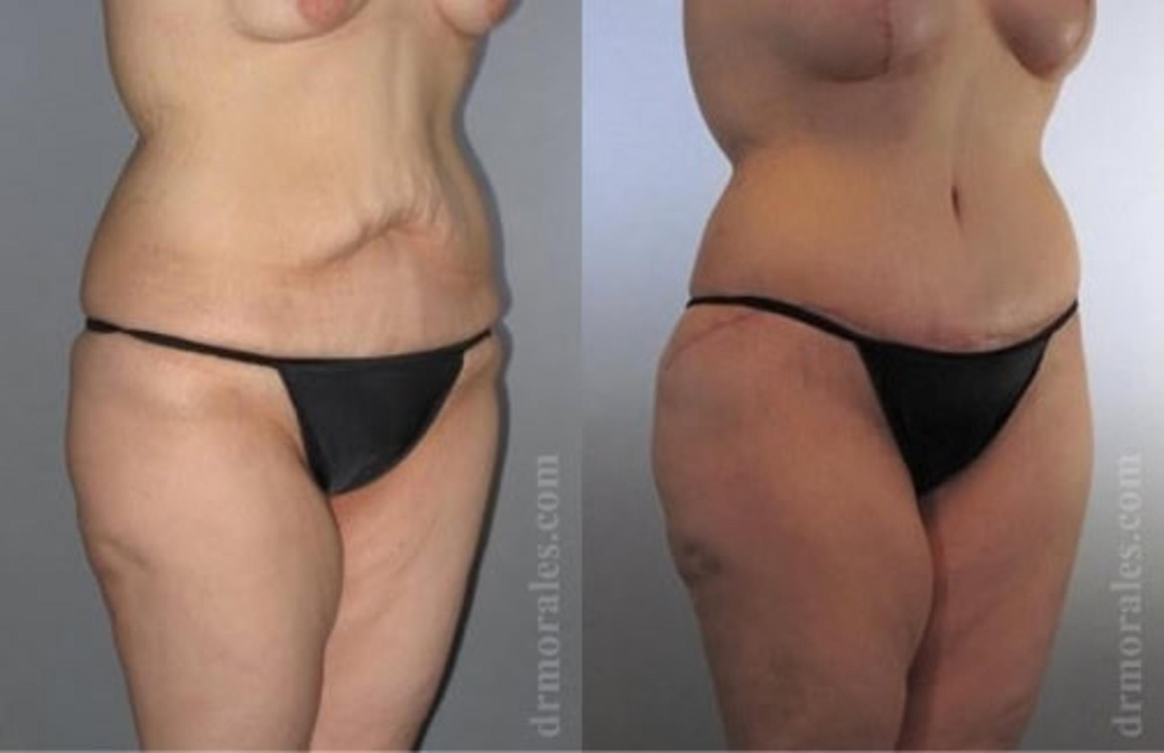 Before & After Tummy Tuck Case 487 View 1 View in Houston, TX