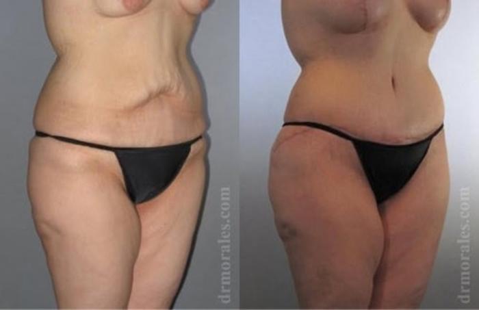 Before & After Tummy Tuck Case 487 View 1 View in Houston, TX