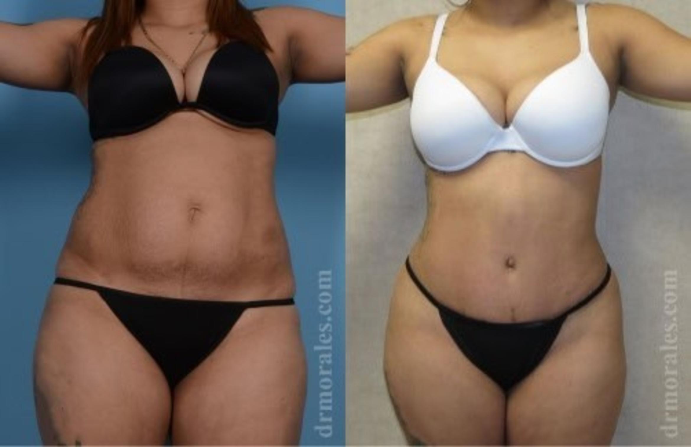Before & After Tummy Tuck Case 488 View 1 View in Houston, TX