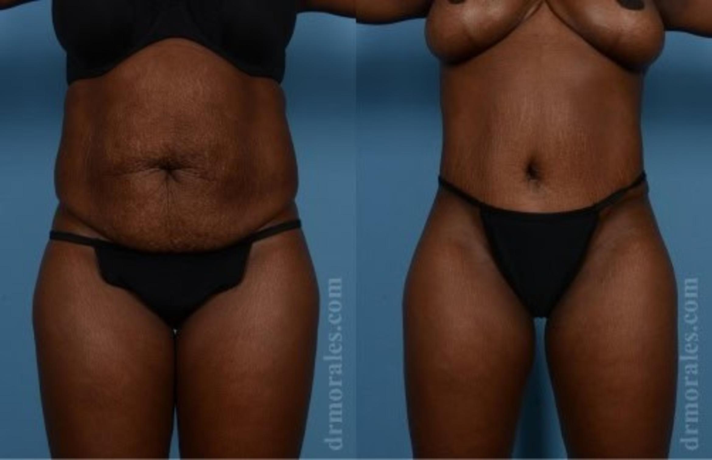 Before & After Tummy Tuck Case 489 View 1 View in Houston, TX