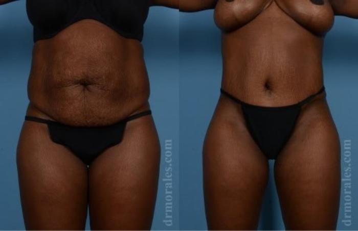 Before & After Tummy Tuck Case 489 View 1 View in Houston, TX