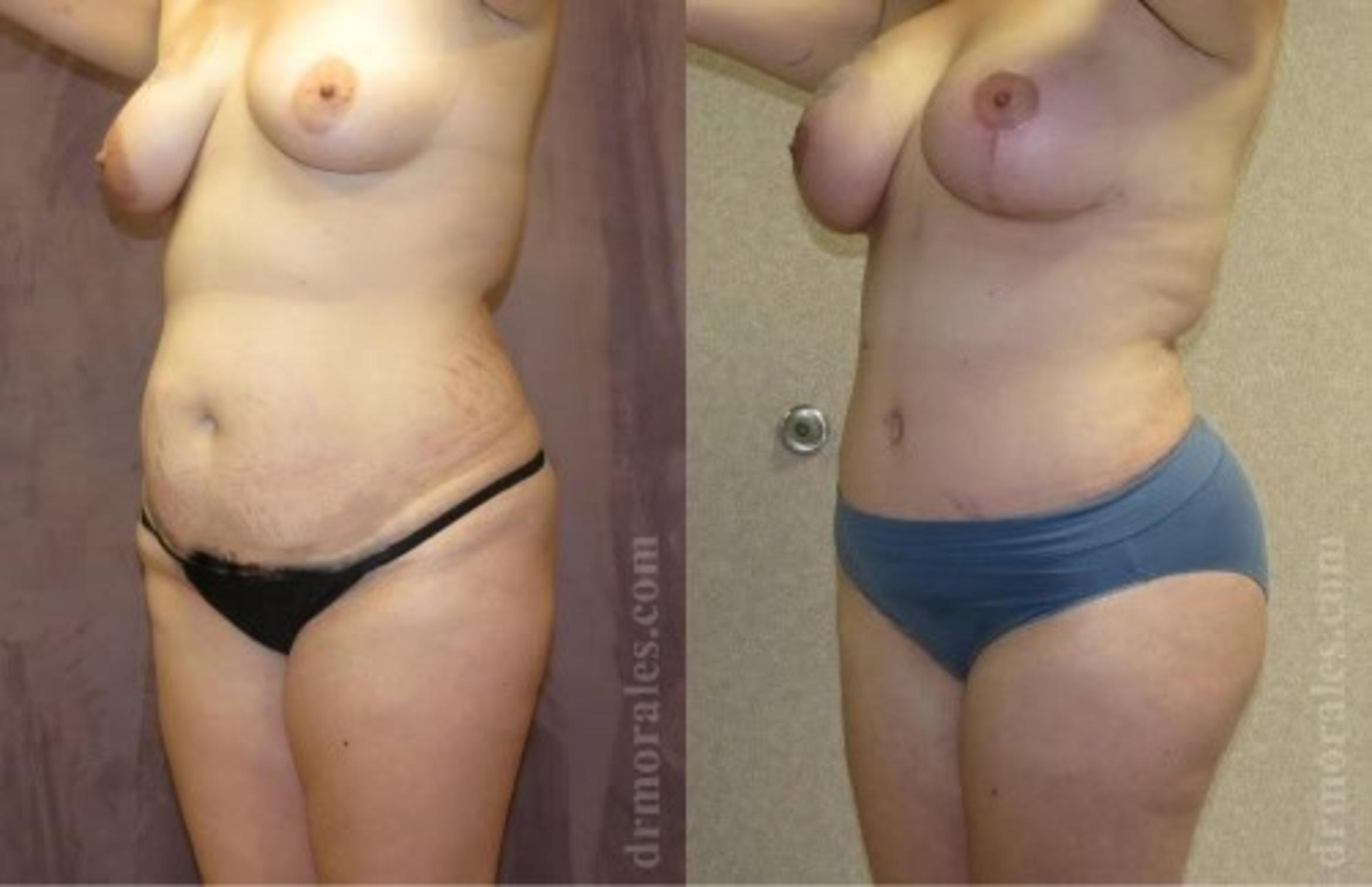 Before & After Tummy Tuck Case 490 View 1 View in Houston, TX
