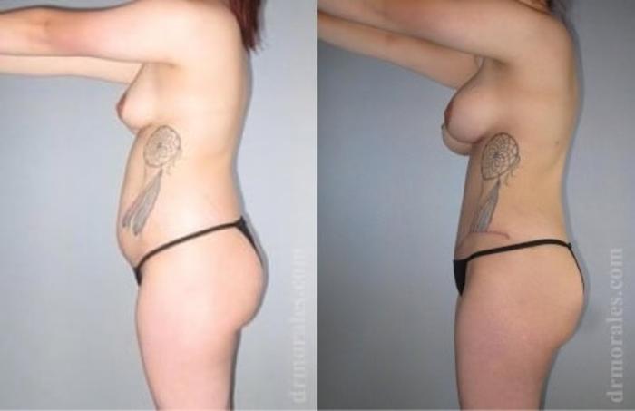 Before & After Tummy Tuck Case 491 View 1 View in Houston, TX