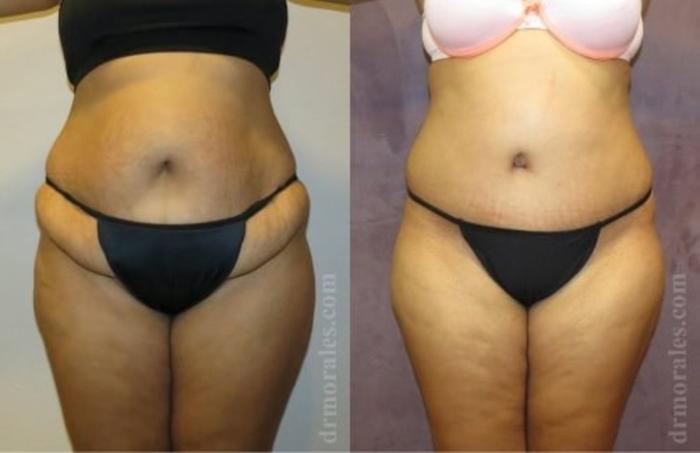 Before & After Tummy Tuck Case 492 View 1 View in Houston, TX