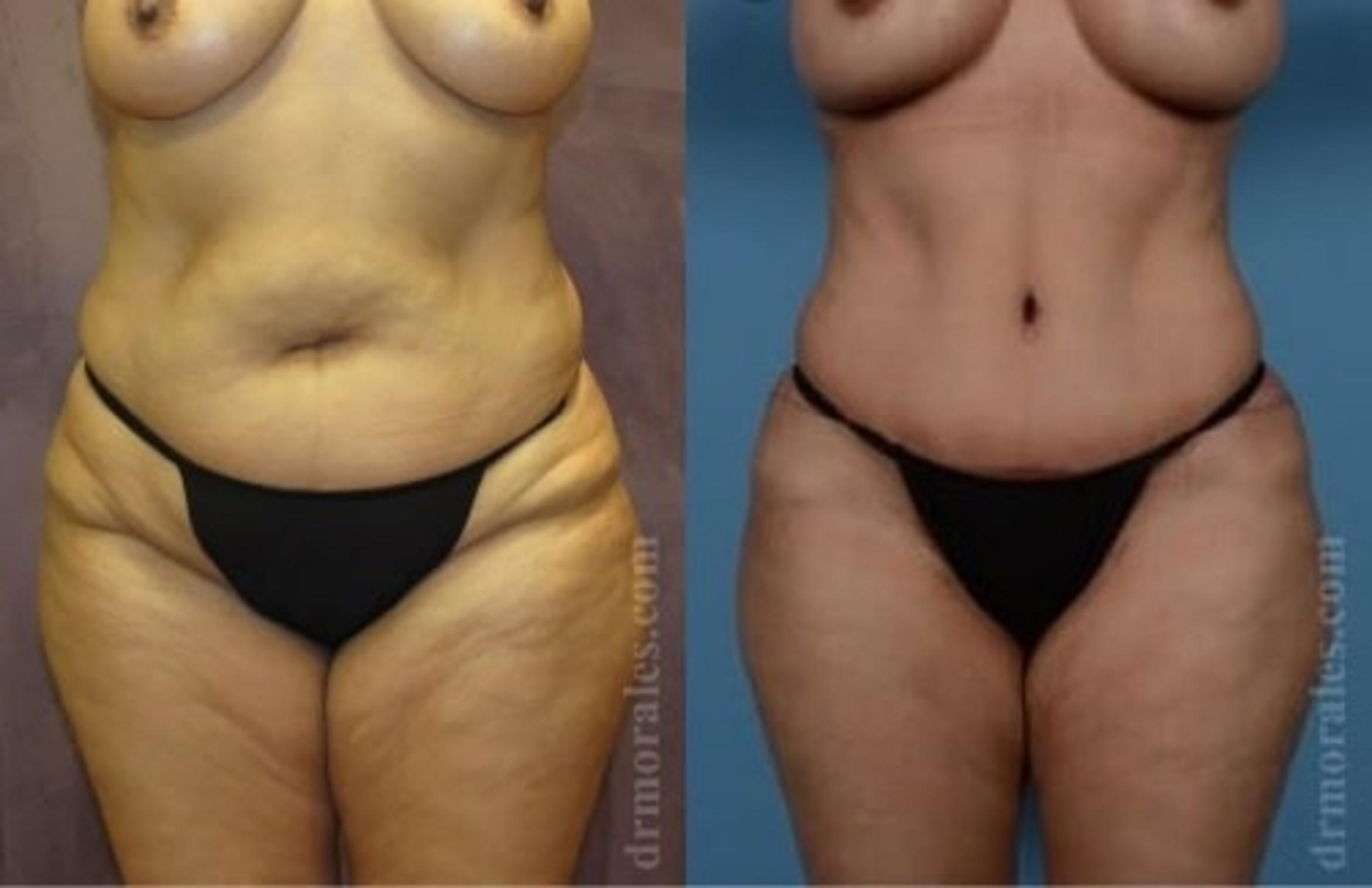 Before & After Tummy Tuck Case 493 View 1 View in Houston, TX