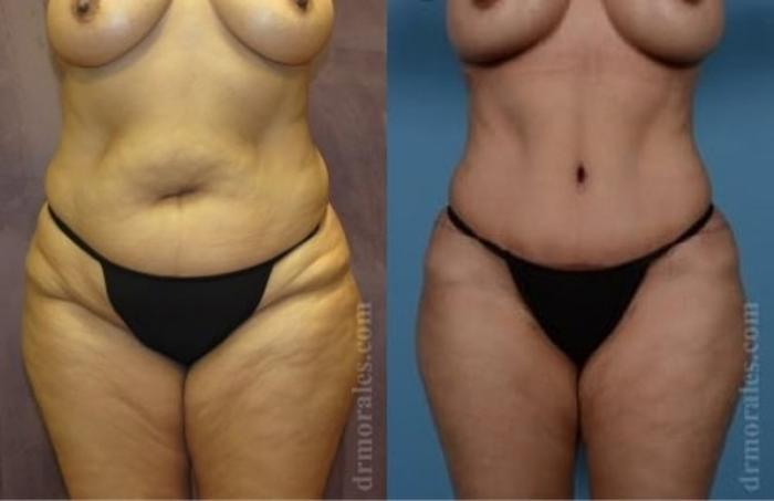 Before & After Tummy Tuck Case 493 View 1 View in Houston, TX