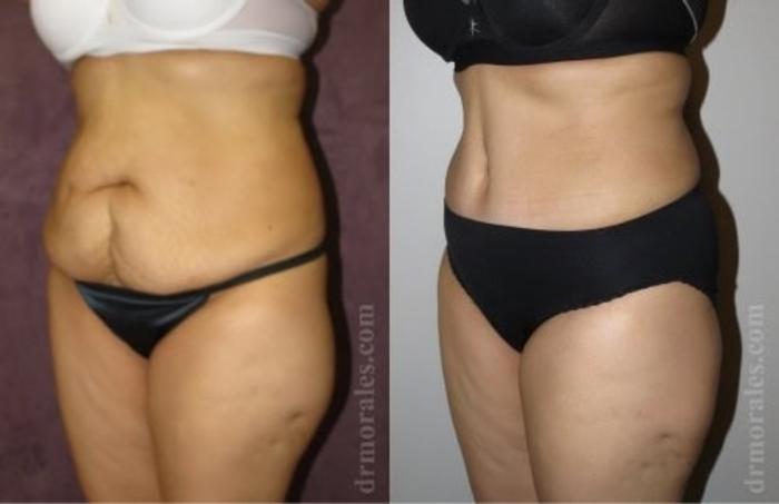 Before & After Tummy Tuck Case 494 View 1 View in Houston, TX