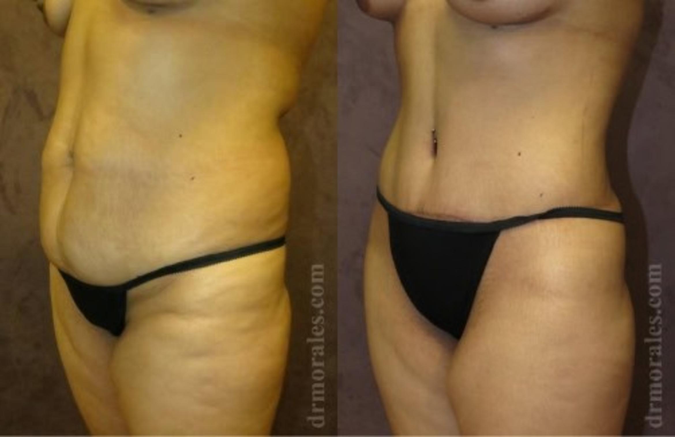 Before & After Tummy Tuck Case 495 View 1 View in Houston, TX