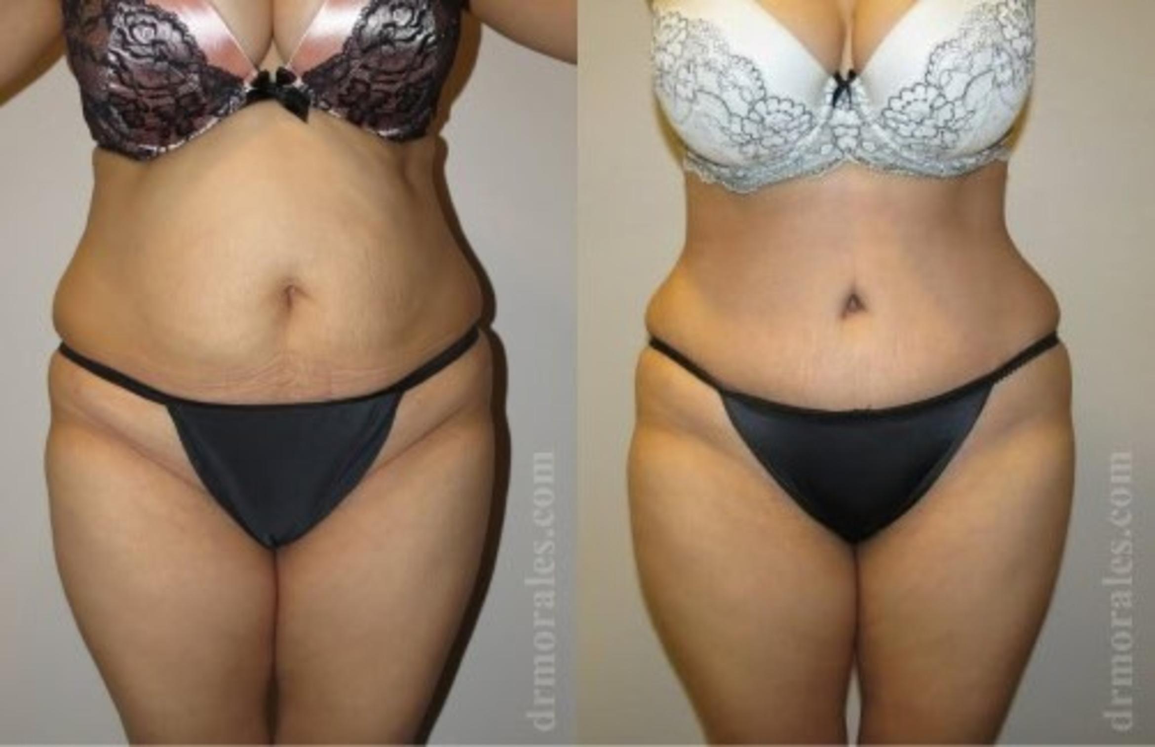 Before & After Tummy Tuck Case 496 View 1 View in Houston, TX