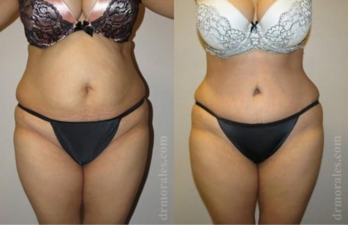 Before & After Tummy Tuck Case 496 View 1 View in Houston, TX
