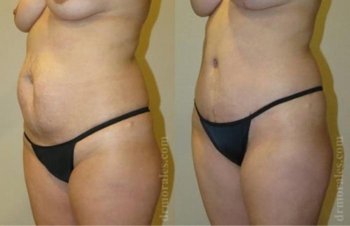 Before & After Tummy Tuck Case 497 View 1 View in Houston, TX