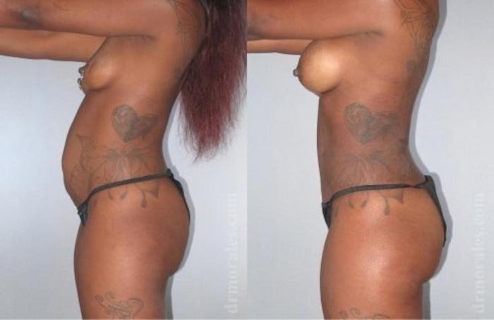 Before & After Tummy Tuck Case 498 View 1 View in Houston, TX