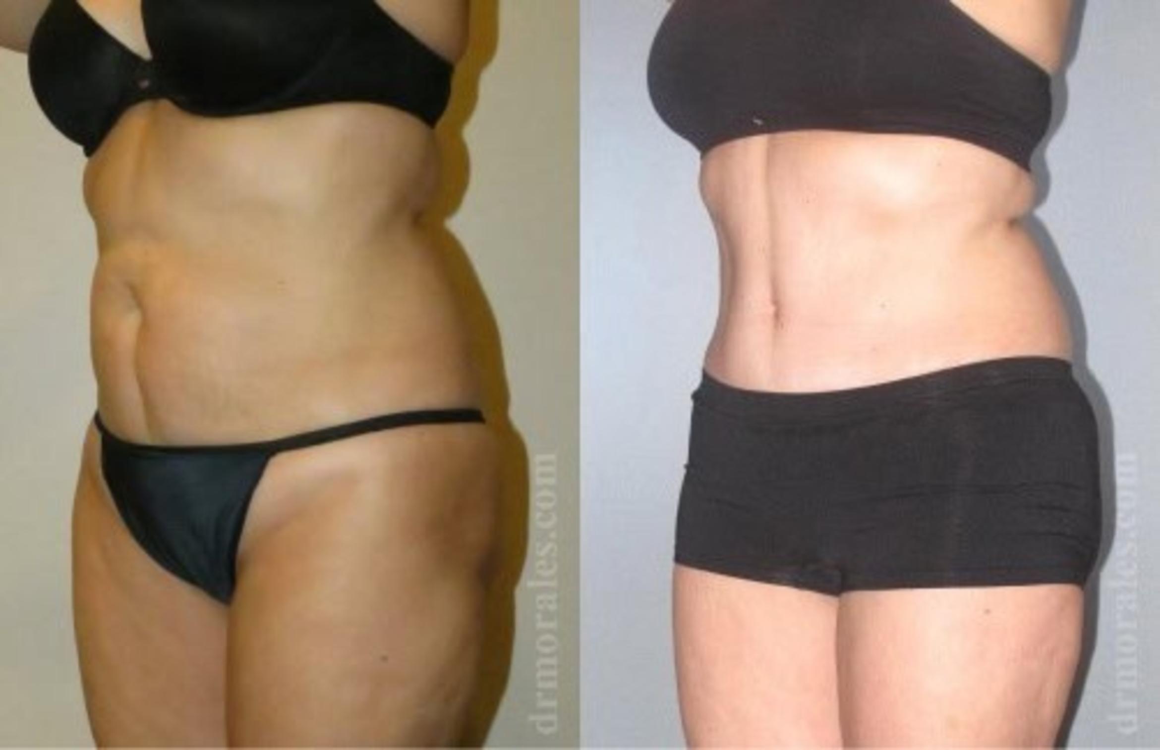Before & After Tummy Tuck Case 499 View 1 View in Houston, TX