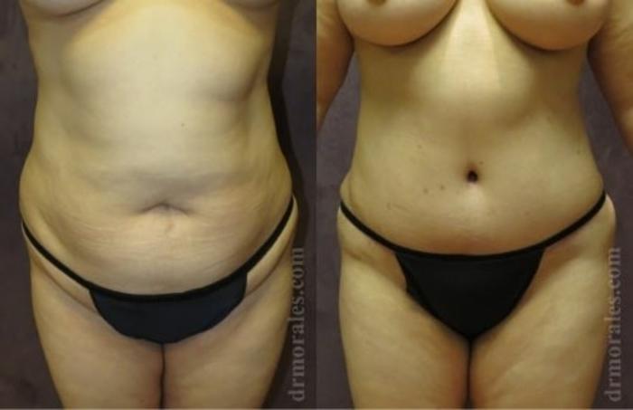 Before & After Tummy Tuck Case 500 View 1 View in Houston, TX
