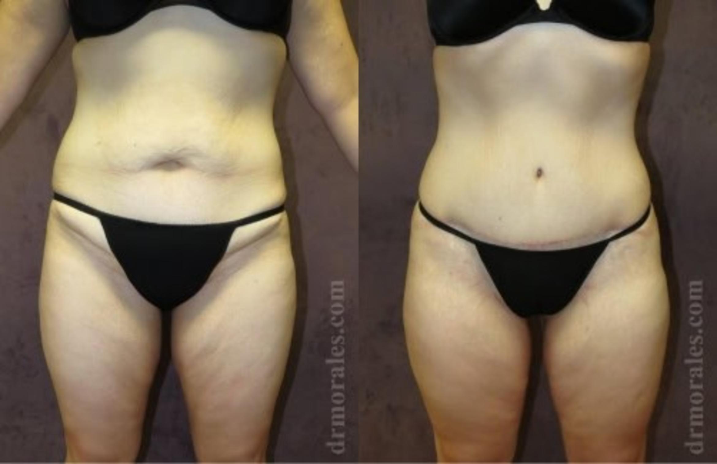 Before & After Tummy Tuck Case 501 View 1 View in Houston, TX