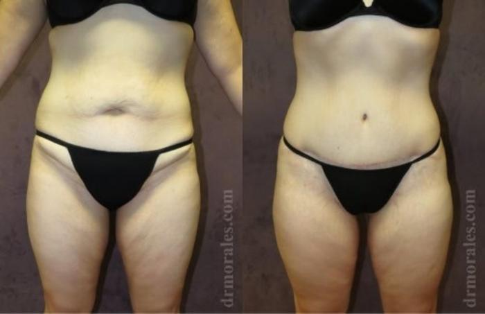 Before & After Tummy Tuck Case 501 View 1 View in Houston, TX
