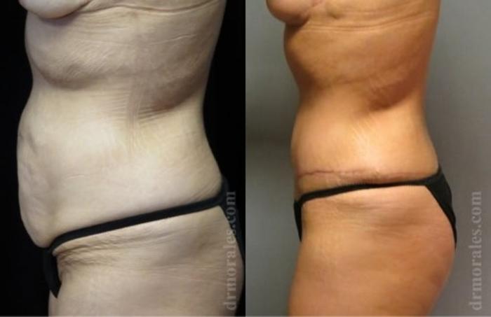 Before & After Tummy Tuck Case 502 View 1 View in Houston, TX