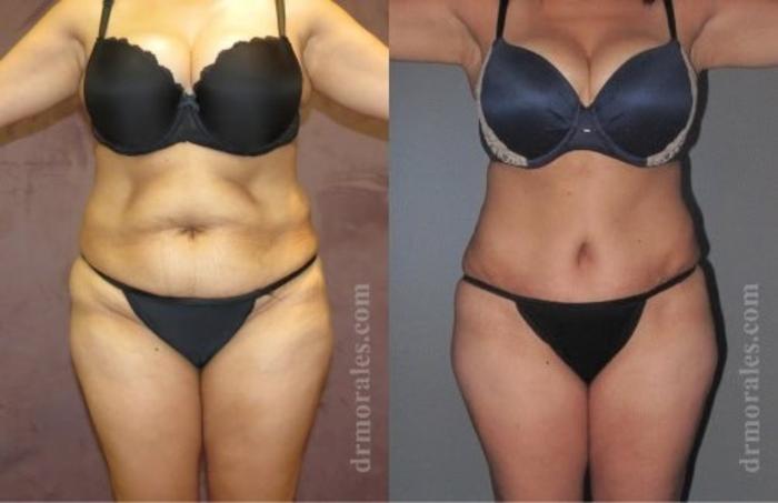Before & After Tummy Tuck Case 503 View 1 View in Houston, TX