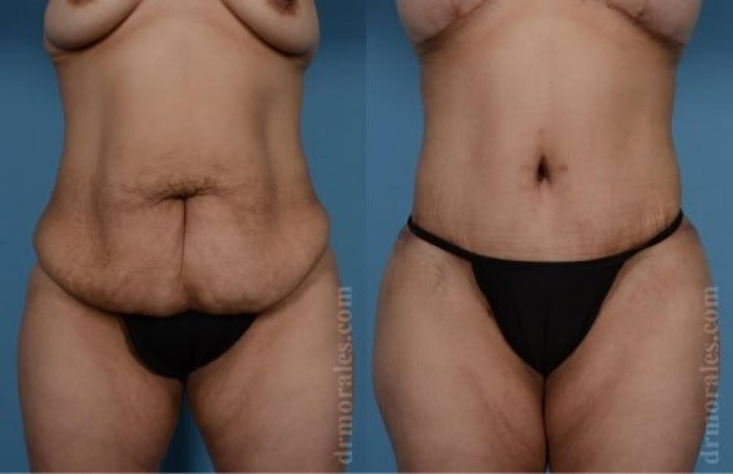 Before & After Tummy Tuck Case 504 View 1 View in Houston, TX