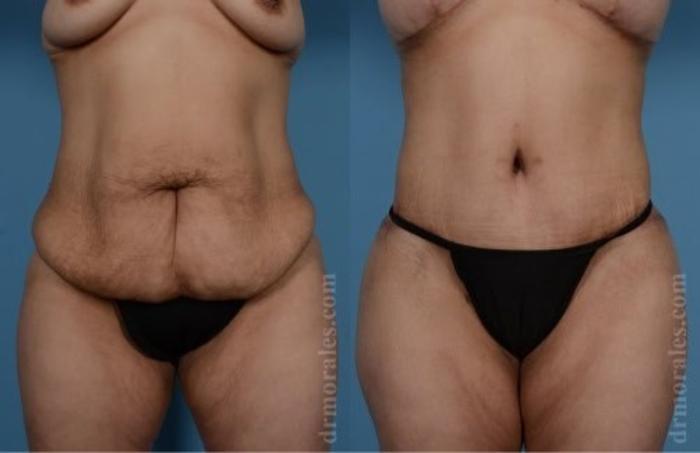 Before & After Tummy Tuck Case 504 View 1 View in Houston, TX