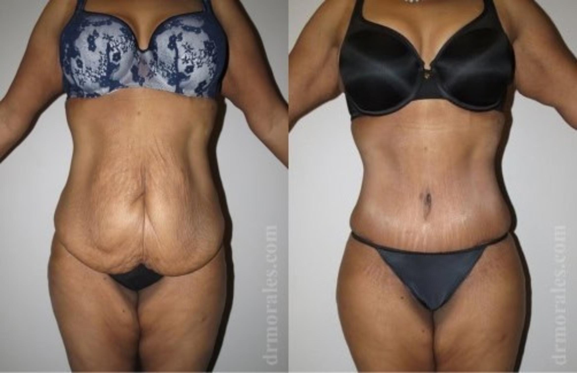 Before & After Tummy Tuck Case 505 View 1 View in Houston, TX
