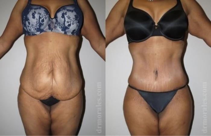 Before & After Tummy Tuck Case 505 View 1 View in Houston, TX