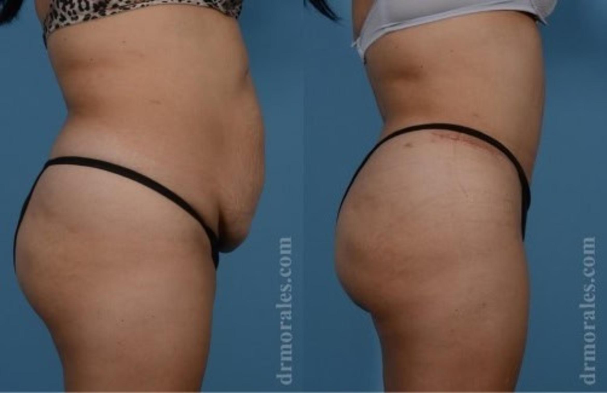 Before & After Tummy Tuck Case 506 View 1 View in Houston, TX