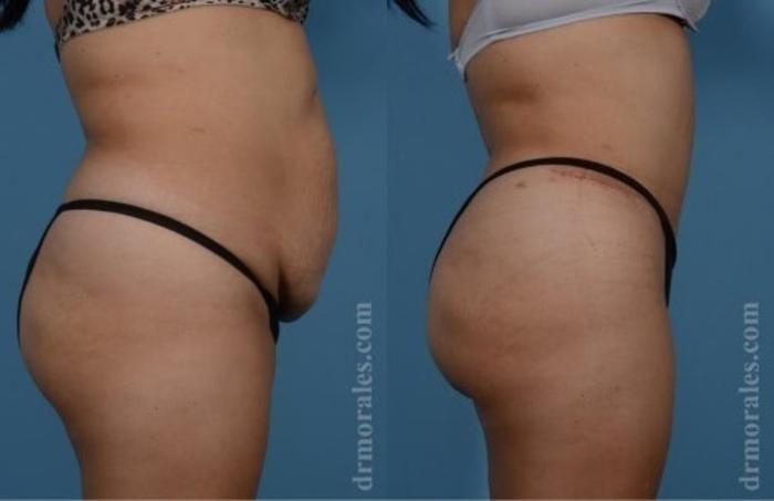 Before & After Tummy Tuck Case 506 View 1 View in Houston, TX