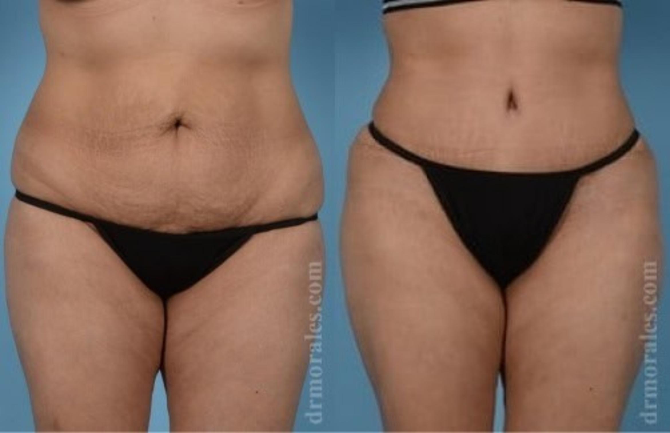 Before & After Tummy Tuck Case 507 View 1 View in Houston, TX