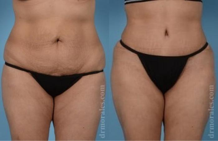 Before & After Tummy Tuck Case 507 View 1 View in Houston, TX