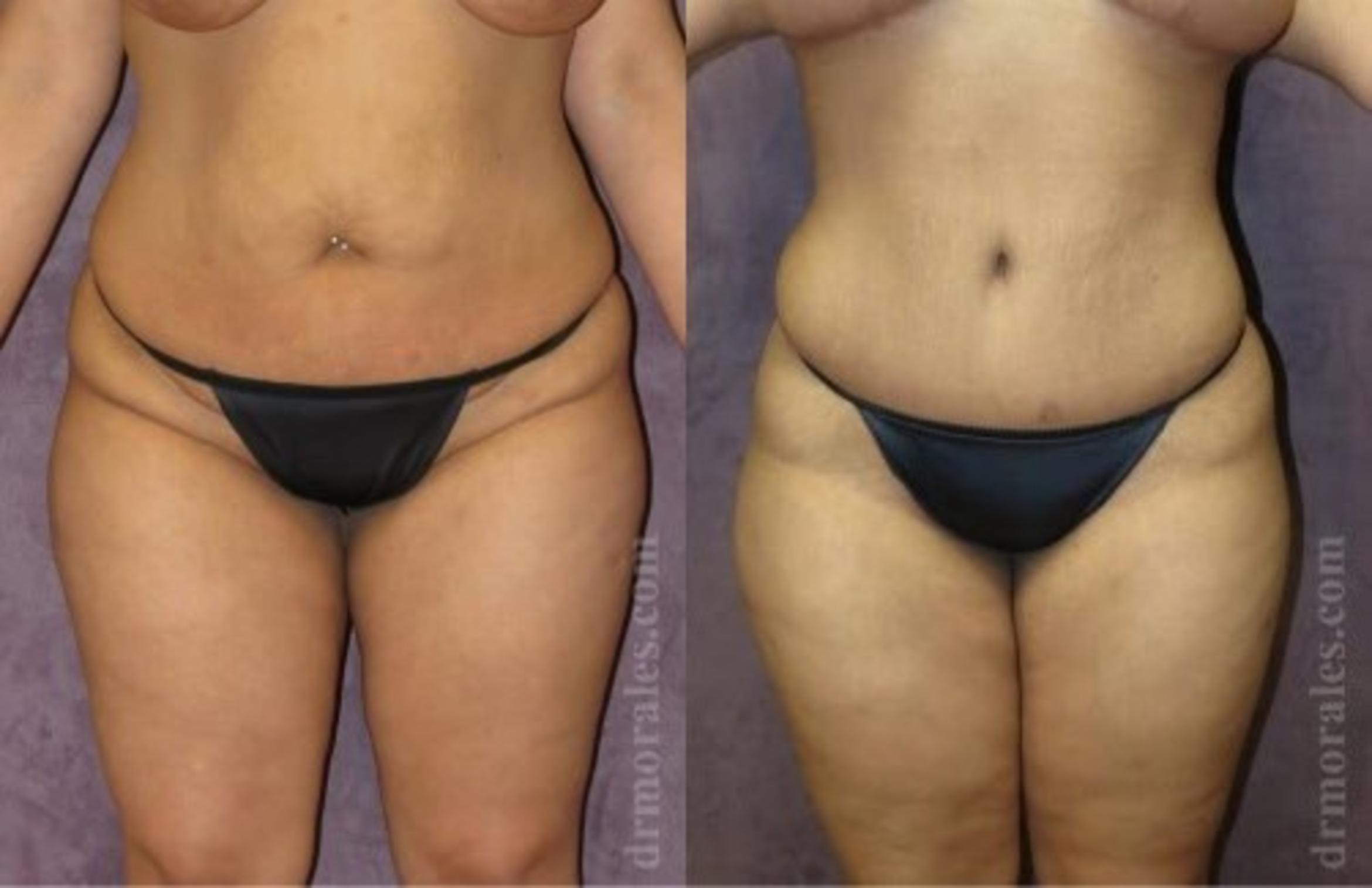 Before & After Tummy Tuck Case 509 View 1 View in Houston, TX