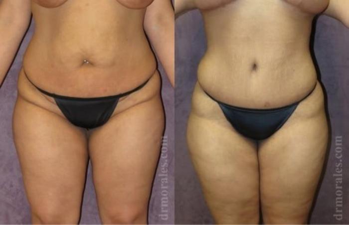 Before & After Tummy Tuck Case 509 View 1 View in Houston, TX