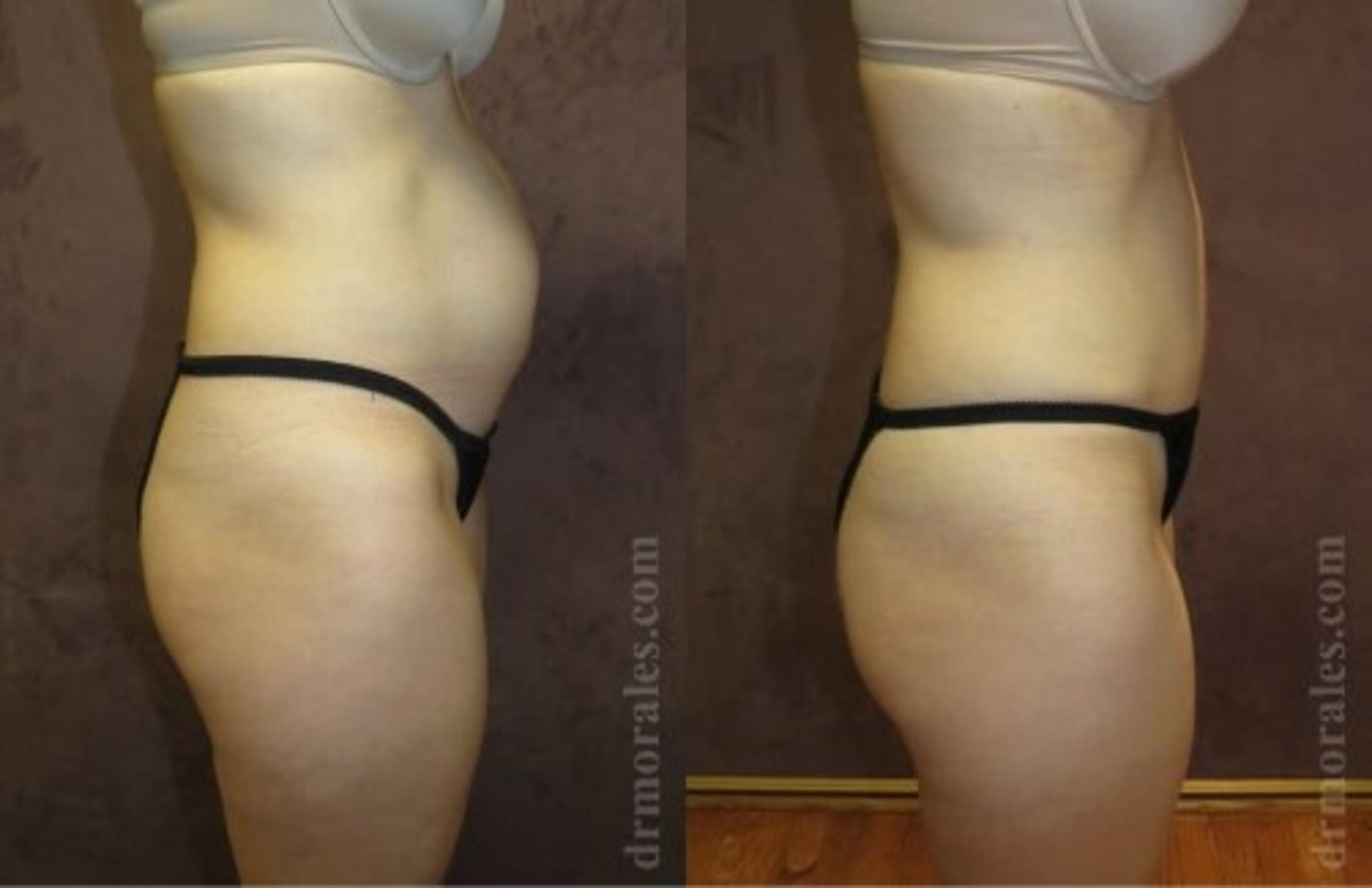 Before & After Tummy Tuck Case 510 View 1 View in Houston, TX