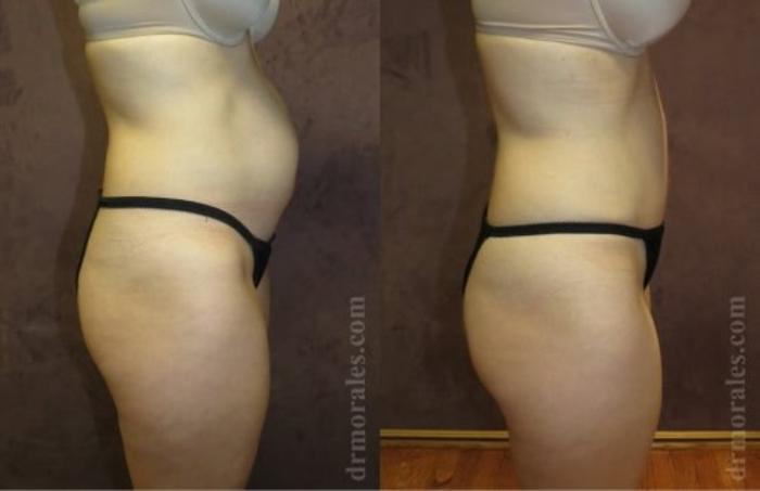 Before & After Tummy Tuck Case 510 View 1 View in Houston, TX