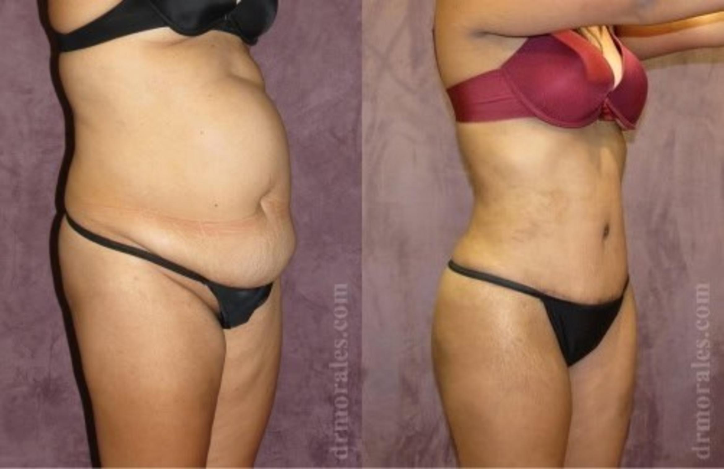 Before & After Tummy Tuck Case 514 View 1 View in Houston, TX