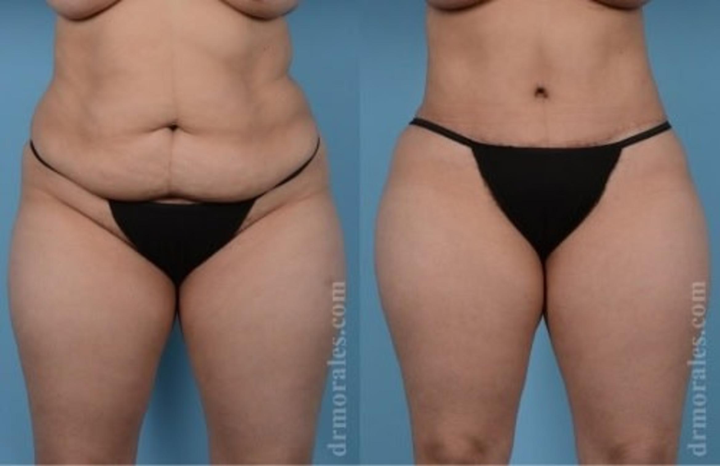 Before & After Tummy Tuck Case 515 View 1 View in Houston, TX