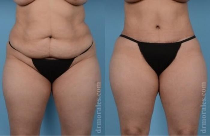 Before & After Tummy Tuck Case 515 View 1 View in Houston, TX