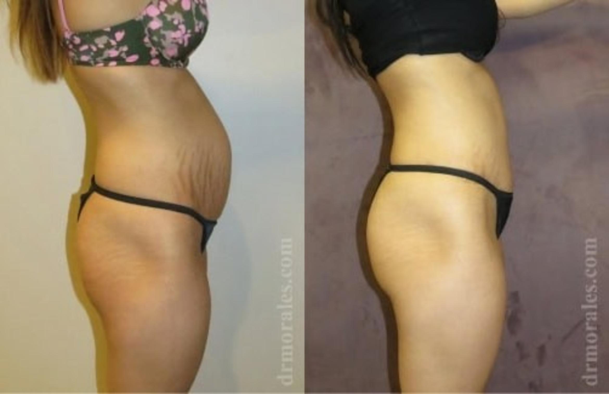 Before & After Tummy Tuck Case 516 View 1 View in Houston, TX
