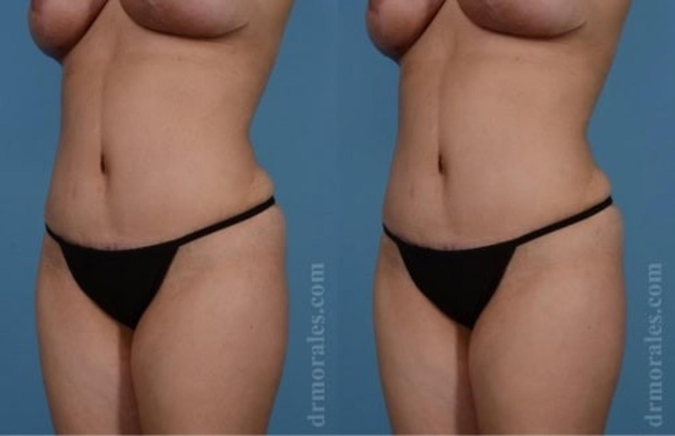 Before & After Tummy Tuck Case 517 View 1 View in Houston, TX