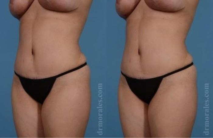 Before & After Tummy Tuck Case 517 View 1 View in Houston, TX