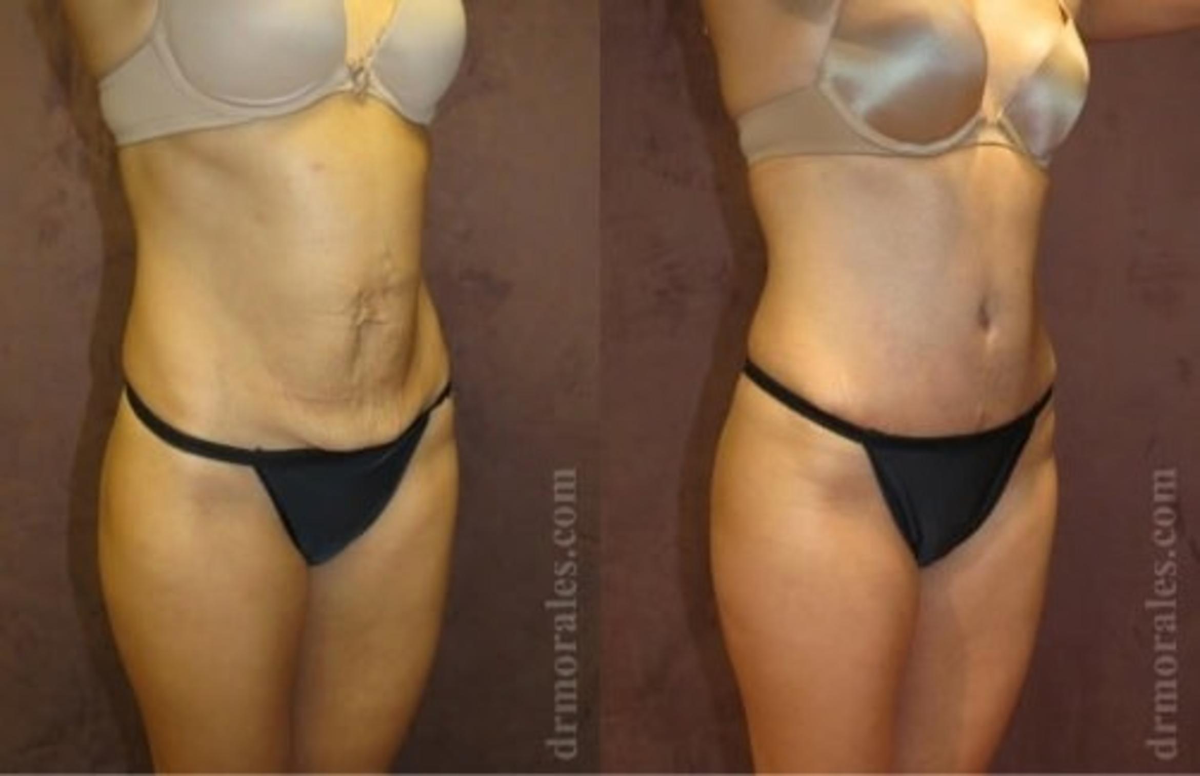 Before & After Tummy Tuck Case 518 View 1 View in Houston, TX