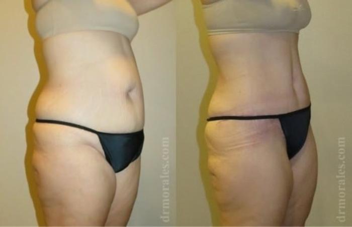 Before & After Tummy Tuck Case 519 View 1 View in Houston, TX