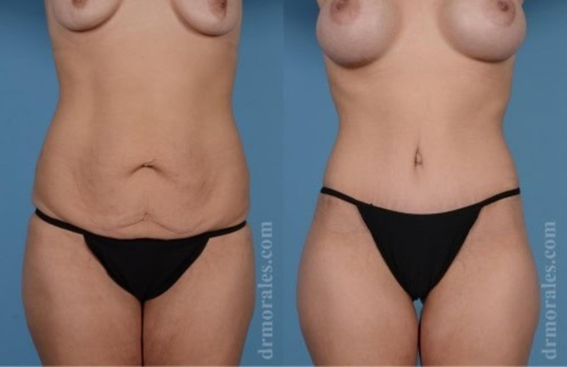 Before & After Tummy Tuck Case 520 View 1 View in Houston, TX