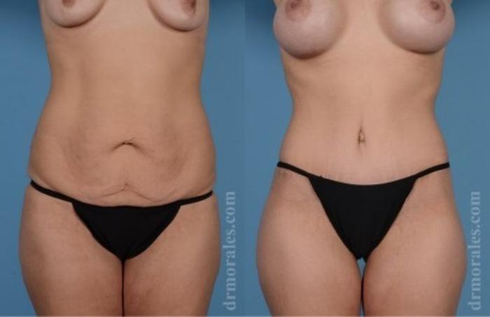 Before & After Tummy Tuck Case 520 View 1 View in Houston, TX