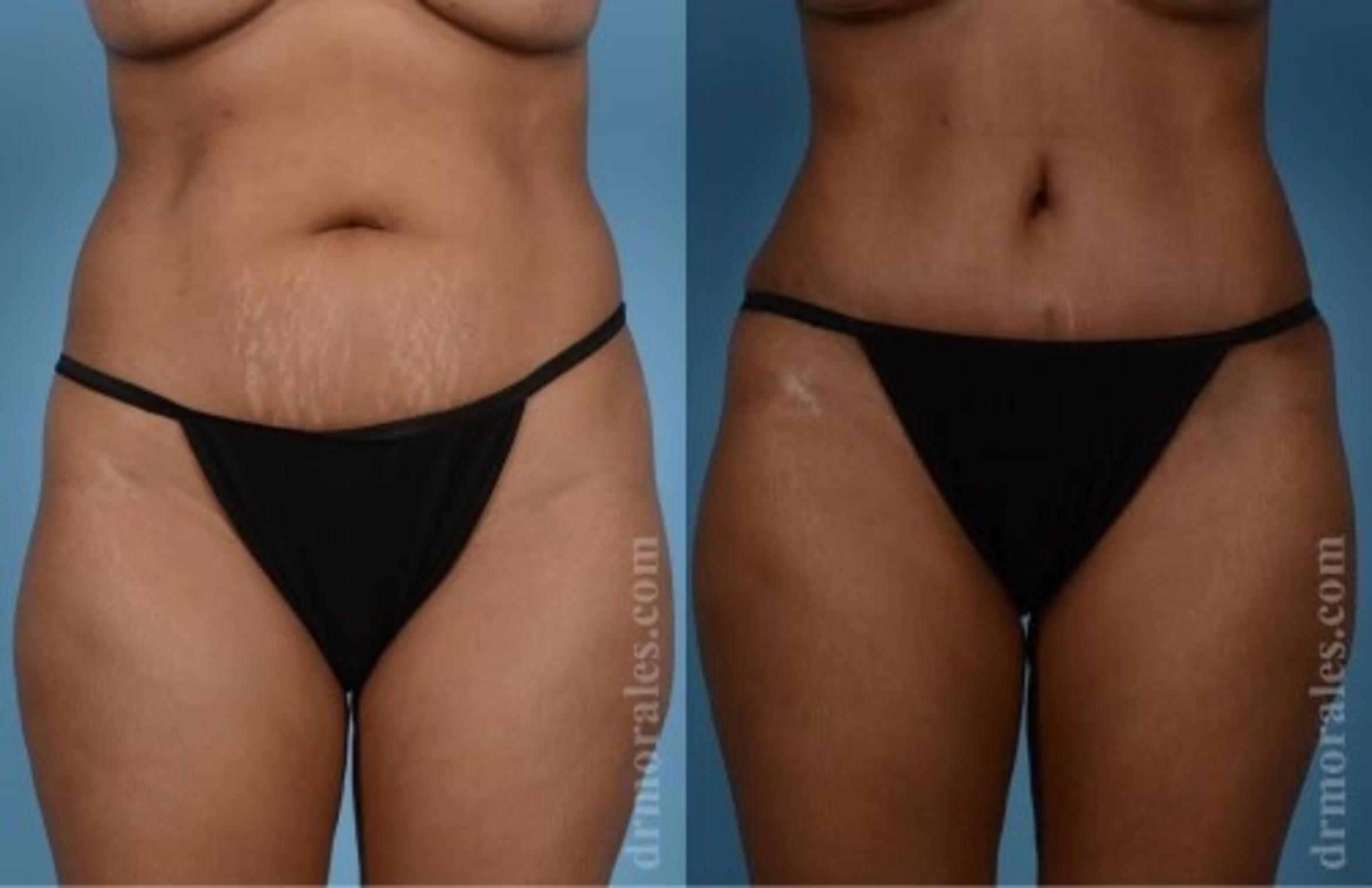 Before & After Tummy Tuck Case 521 View 1 View in Houston, TX