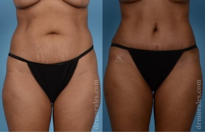 Before & After Tummy Tuck Case 521 View 1 View in Houston, TX